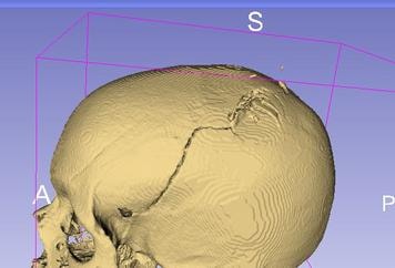 Skull biomechanical reference for injury analysis